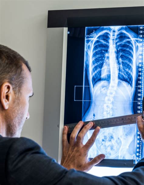 Accurate Scoliosis Assessment Is The Key Scolicare Naples Florida