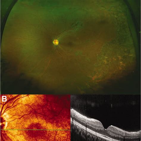 Fundus Photograph Of The Left Eye Obtained 2 Months After Retinal Download Scientific Diagram