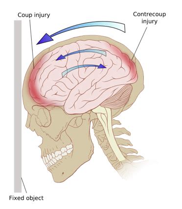 Traumatic Brain Injury Flashcards Quizlet