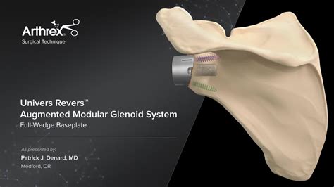 Arthrex Univers Revers Augmented Modular Glenoid System Full Wedge