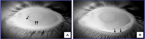 Effects On The Human Tear Film Of Applying Skin Lipids To Th Cornea