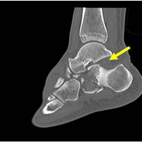 Coronal and sagittal views of the ankle CT scan showing intraarticular ...