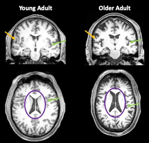 Even Mild Cases Of Covid Can Leave A Mark On The Brain Such As