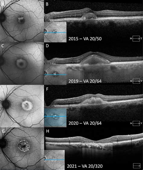 Frontiers Adult Onset Foveomacular Vitelliform Dystrophy Epidemiology Pathophysiology