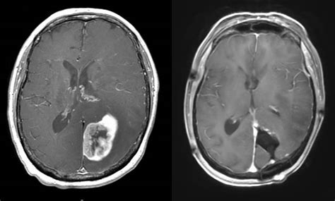 Techniques To Improve The Extent Of Brain Tumor Resection Awake