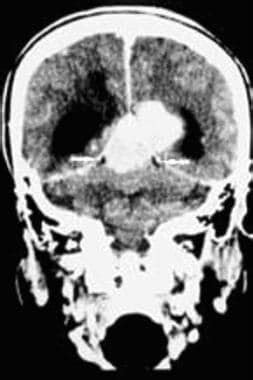 Brain Meningioma Imaging Practice Essentials Radiography Computed