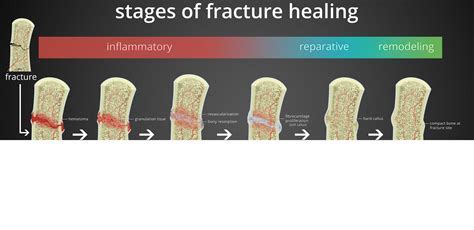 Bone healing | Antrim ED Meducation