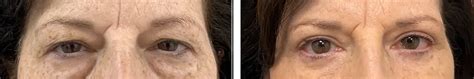 4 Lid Blepharoplasty Before And After Photo Gallery A Rabinovich