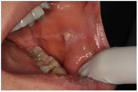 Symmetry Free Full Text Prevalence And Characteristic Of Oral Mucosa Lesions