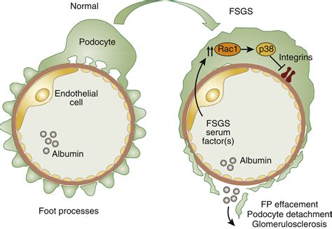 Losing Their Footing Rac Signaling Causes Podocyte Detachment And