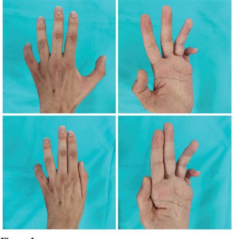 Figure 2 From The Treatment Of Advanced Cubital Tunnel Syndrome In A