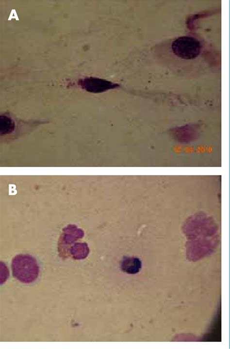 Figure 3 from Utilità della citologia congiuntivale nella diagnosi e