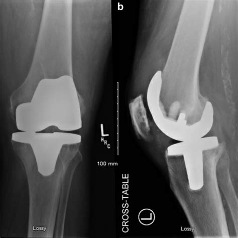 A Anteroposterior And B Lateral Radiographs Of The Left Knee At The Download Scientific