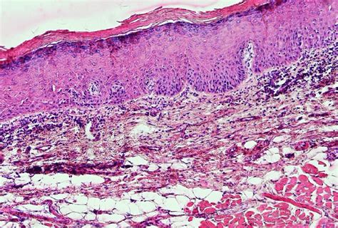 A Photomicrograph Of A Leukoplakic Lesion Showing Mild Epithelial