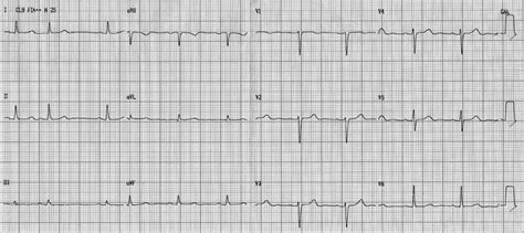 Ecg‐1 Performed On 160118 At 10 Am Sinus Tachycardia Heart Rate