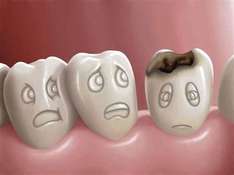 Sab As Que La Caries Es Una Enfermedad Prevenible Cl Nica