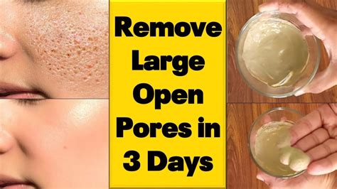 How To Get Rid Of Large Open Pores Permanently In Just 3 Days Diy