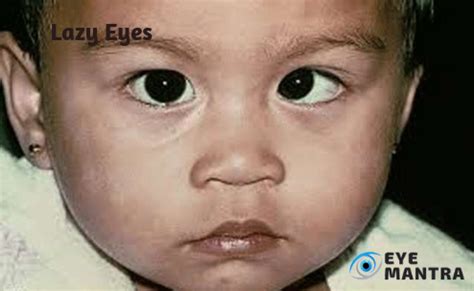 Eye Diseases | All types, causes, symptoms and treatment | EyeMantra