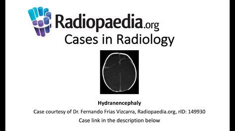 Hydranencephaly Cases In Radiology Youtube