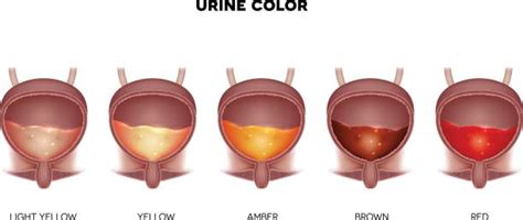 Ematuria Sangue Nelle Urine Andrologo E Urologo Milano Dott