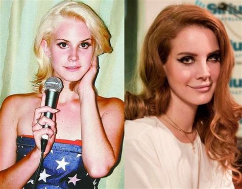 Lana Del Rey - Plastic surgery on her nose and lips?