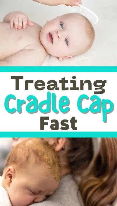 Cradle Cap How To Treat It Fast Currently Jess