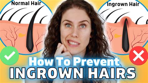 How To Get Rid Of Ingrown Hairs Advice From A Medical Esthetician Youtube