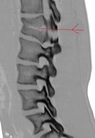 Chance Fractures Statpearls Ncbi Bookshelf