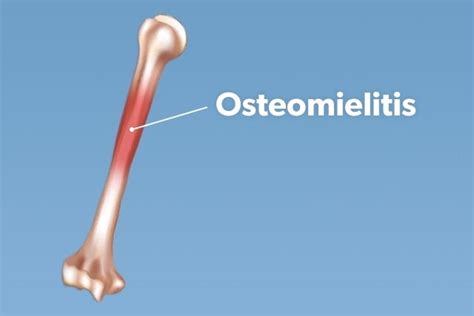 Osteomielitis Qué Es Síntomas Y Tratamiento Tua Saúde