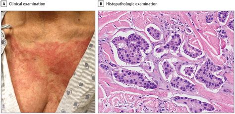 An Erysipeloid Cutaneous Eruption In A Woman With Advanced Breast Cancer Breast Cancer Jama