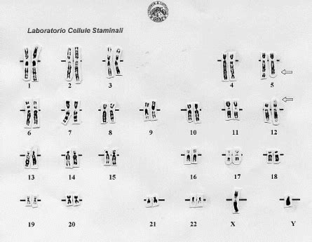 G Banded Karyotype Of Bone Marrow Cells Showing Xy T Q P