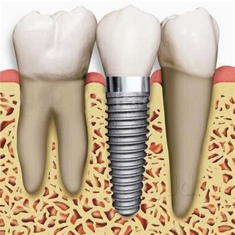 Best Dental Implants In Plateau Mont Royal Tooth Implant In Montreal