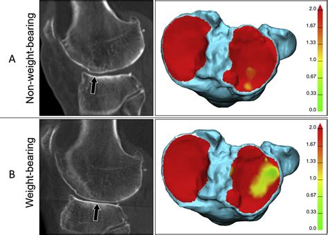 Three Dimensional Analysis For Quantification Of Knee Joint Space Width