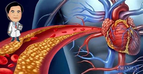 Dr Willie Ong Explains The 4 Symptoms Of Blocked Arteries The