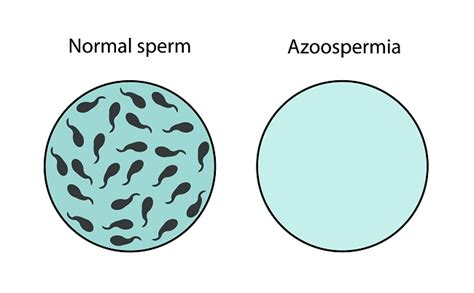 Diagnosis Azoospermia Alomedika