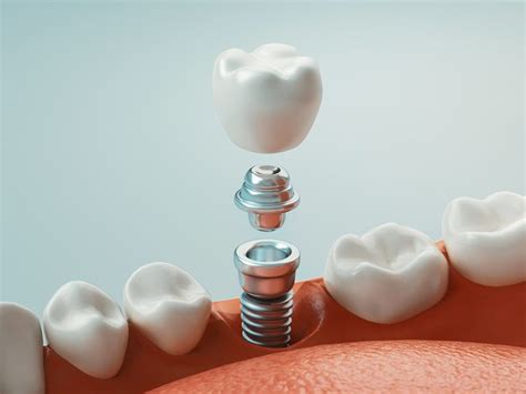 Implantes Dentales Para Personas Mayores Dentistas En Palma