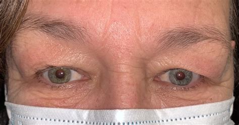 21 Upper Eyelid Surgery Before And After Photos Dallas Plano Texas Cosmetic Reconstructive