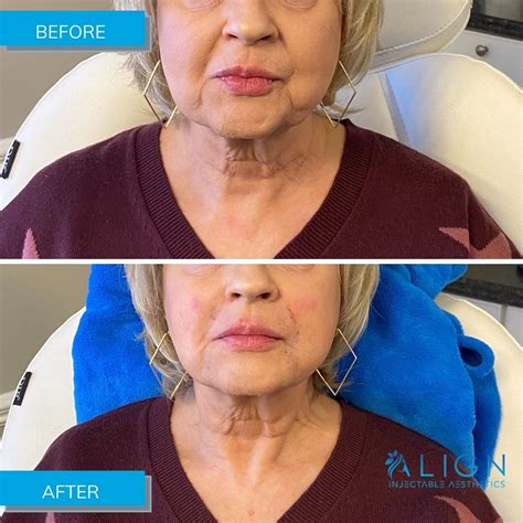 Before After Results Align Injectable Aesthetics