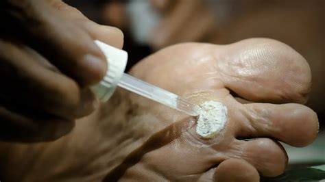 methods  wart removal cryotherapy laser therapy home remedies