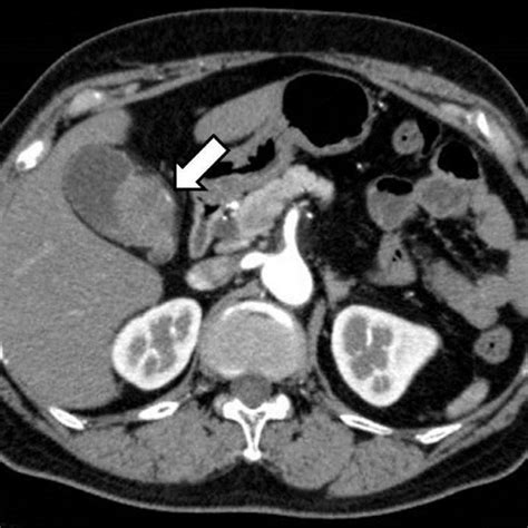 Positron Emission Tomography Computed Tomography Scan 7 Months After