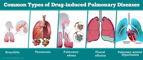 Drug Induced Pulmonary Diseases Types Symptoms And Treatment