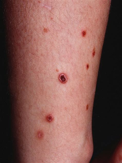 Pityriasis Rosea Legs