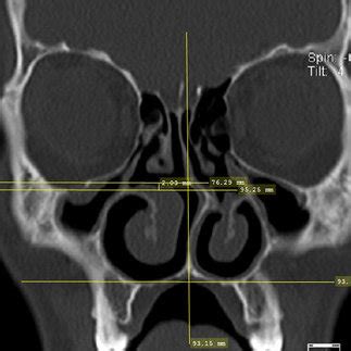 Bolger Classification A Type 1 Hypoplasia Maxillary Sinuses Have A