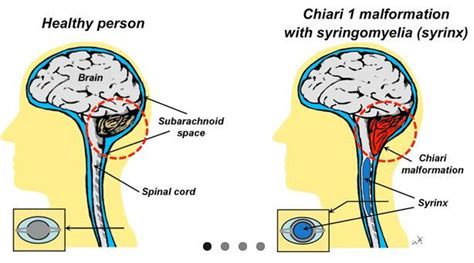 Arnold Chiari Malformation Diagram