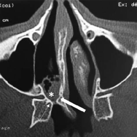 Facial Ct Scan Axial Bone Window Right Mixed Choanal Atresia With Download Scientific