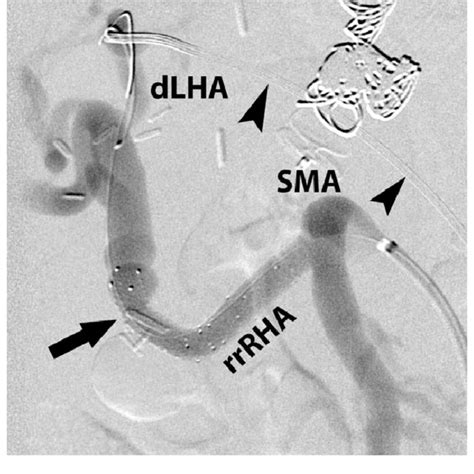 Superior mesenteric artery (SMA) arteriogram in the left oblique... | Download Scientific Diagram