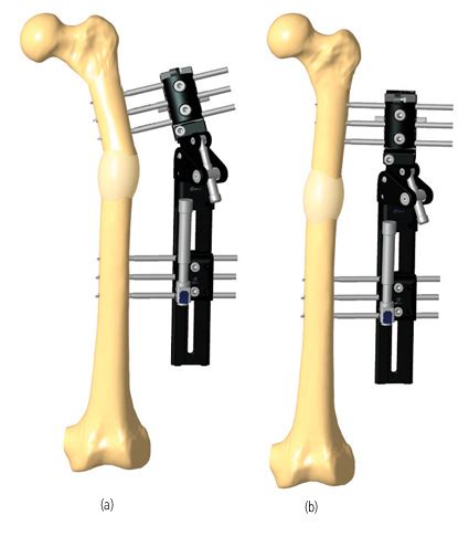 Correction Of Femur Deformity With Lengthening Orthofix Abs