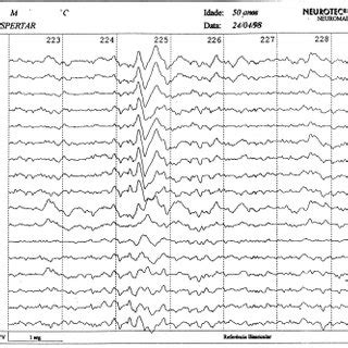 Eeg Evidencia Atividade Epileptiforme De Proje O Frontotemporal