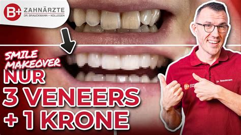 Sch Ne Neue Z Hne Bekommen Durch Veneers Und Eine Krone Inklusive