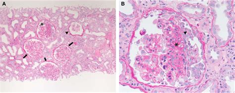 Light microscopy of the kidney biopsy. (A) Light microscopy showing a ...